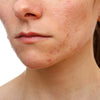 Natural Ingredients that Help Fade Acne Scars